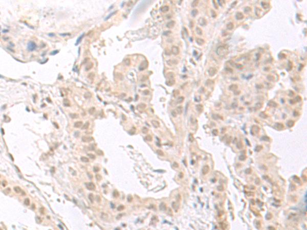 HOOK2 Antibody - Immunohistochemistry of paraffin-embedded Human thyroid cancer tissue  using HOOK2 Polyclonal Antibody at dilution of 1:30(×200)