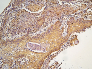 HOOK3 Antibody - IHC staining of FFPE human esophageal squamous cancer with HOOK3 antibody at 1ug/ml. HIER: boil tissue sections in pH6, 10mM citrate buffer, for 10-20 min and allow to cool before testing.