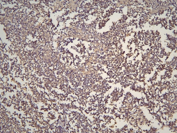 HOOK3 Antibody - IHC staining of FFPE human glioma with HOOK3 antibody at 1ug/ml. HIER: boil tissue sections in pH6, 10mM citrate buffer, for 10-20 min and allow to cool before testing.