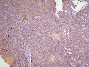 HOOK3 Antibody - IHC staining of FFPE human sarcoma with HOOK3 antibody at 1ug/ml. HIER: boil tissue sections in pH6, 10mM citrate buffer, for 10-20 min and allow to cool before testing.
