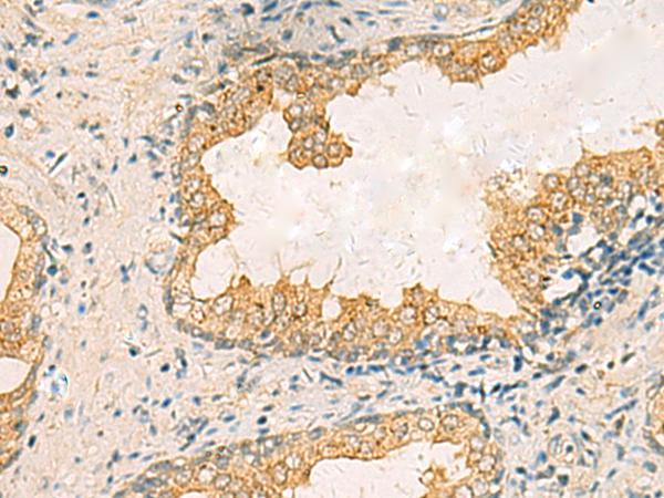 HORMAD2 Antibody - Immunohistochemistry of paraffin-embedded Human prost ate cancer tissue  using HORMAD2 Polyclonal Antibody at dilution of 1:35(×200)