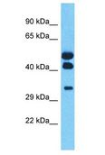 HOXA11 Antibody - HOXA11 antibody Western Blot of Ovary Tumor. Antibody dilution: 1 ug/ml.  This image was taken for the unconjugated form of this product. Other forms have not been tested.
