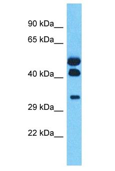 HOXA11 Antibody - HOXA11 antibody Western Blot of Ovary Tumor. Antibody dilution: 1 ug/ml.  This image was taken for the unconjugated form of this product. Other forms have not been tested.