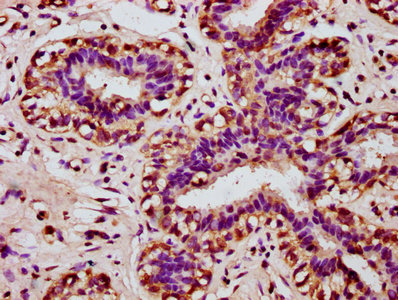 HOXA11 Antibody - Immunohistochemistry Dilution at 1:100 and staining in paraffin-embedded human breast cancer performed on a Leica BondTM system. After dewaxing and hydration, antigen retrieval was mediated by high pressure in a citrate buffer (pH 6.0). Section was blocked with 10% normal Goat serum 30min at RT. Then primary antibody (1% BSA) was incubated at 4°C overnight. The primary is detected by a biotinylated Secondary antibody and visualized using an HRP conjugated SP system.