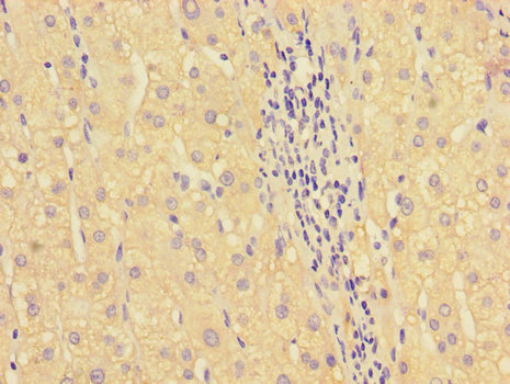 HOXA2 Antibody - Immunohistochemistry of paraffin-embedded human liver cancer tissue using HOXA2 Antibody at dilution of 1:100
