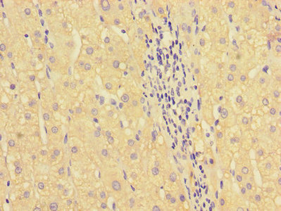 HOXA2 Antibody - Immunohistochemistry of paraffin-embedded human liver cancer using HOXA2 Antibody at dilution of 1:100
