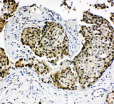 HOXA4 Antibody - HOXA4 antibody. IHC(P): Human Breast Cancer Tissue.