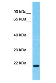HOXA7 Antibody - HOXA7 antibody Western Blot of Colorectal Tumor. Antibody dilution: 1 ug/ml.  This image was taken for the unconjugated form of this product. Other forms have not been tested.