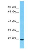 HOXA7 Antibody - HOXA7 antibody Western Blot of Colorectal Tumor. Antibody dilution: 1 ug/ml.  This image was taken for the unconjugated form of this product. Other forms have not been tested.