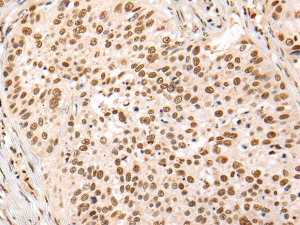 HOXA7 Antibody - Immunohistochemistry of paraffin-embedded Human lung cancer tissue  using HOXA7 Polyclonal Antibody at dilution of 1:70(×200)