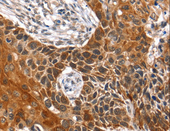 HOXB1 Antibody - Immunohistochemistry of paraffin-embedded Human esophagus cancer using HOXB1 Polyclonal Antibody at dilution of 1:40.