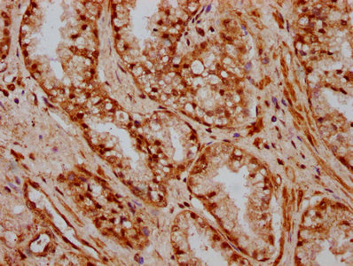 HOXB3 Antibody - Immunohistochemistry Dilution at 1:600 and staining in paraffin-embedded human prostate cancer performed on a Leica BondTM system. After dewaxing and hydration, antigen retrieval was mediated by high pressure in a citrate buffer (pH 6.0). Section was blocked with 10% normal Goat serum 30min at RT. Then primary antibody (1% BSA) was incubated at 4°C overnight. The primary is detected by a biotinylated Secondary antibody and visualized using an HRP conjugated SP system.