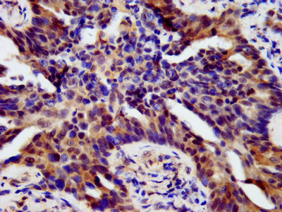 HOXB4 Antibody - Immunohistochemistry image at a dilution of 1:500 and staining in paraffin-embedded human lung cancer performed on a Leica BondTM system.