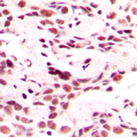 HOXB9 Antibody - Immunohistochemical analysis of HOXB9 staining in human breast cancer formalin fixed paraffin embedded tissue section. The section was pre-treated using heat mediated antigen retrieval with sodium citrate buffer (pH 6.0). The section was then incubated with the antibody at room temperature and detected using an HRP conjugated compact polymer system. DAB was used as the chromogen. The section was then counterstained with hematoxylin and mounted with DPX.