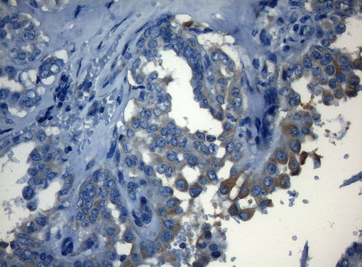 HOXC10 Antibody - Immunohistochemical staining of paraffin-embedded Carcinoma of Human thyroid tissue using anti-HOXC10 mouse monoclonal antibody. (Heat-induced epitope retrieval by 1mM EDTA in 10mM Tris buffer. (pH8.5) at 120°C for 3 min. (1:150)