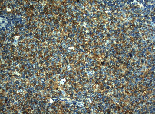 HOXC10 Antibody - Immunohistochemical staining of paraffin-embedded Human lymphoma tissue using anti-HOXC10 mouse monoclonal antibody. (Heat-induced epitope retrieval by 1mM EDTA in 10mM Tris buffer. (pH8.5) at 120°C for 3 min. (1:150)