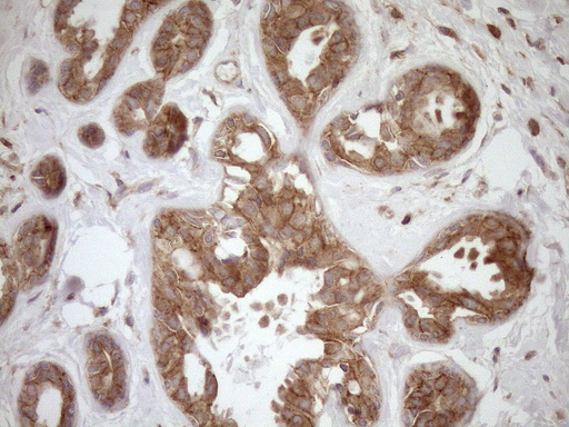 HOXC10 Antibody - Immunohistochemical staining of paraffin-embedded Adenocarcinoma of Human breast tissue using anti-HOXC10 mouse monoclonal antibody. (Heat-induced epitope retrieval by 1mM EDTA in 10mM Tris buffer. (pH8.5) at 120°C for 3 min. (1:150)