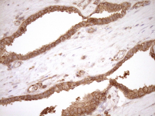 HOXC10 Antibody - Immunohistochemical staining of paraffin-embedded Carcinoma of Human prostate tissue using anti-HOXC10 mouse monoclonal antibody. (Heat-induced epitope retrieval by 1mM EDTA in 10mM Tris buffer. (pH8.5) at 120°C for 3 min. (1:150)
