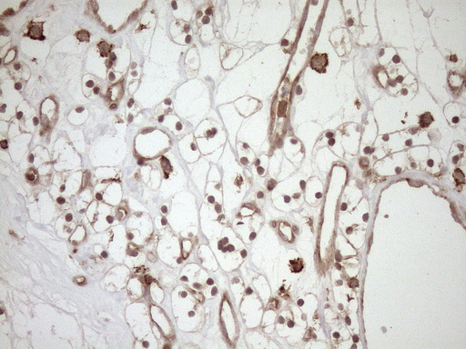 HOXC10 Antibody - Immunohistochemical staining of paraffin-embedded Carcinoma of Human kidney tissue using anti-HOXC10 mouse monoclonal antibody. (Heat-induced epitope retrieval by 1mM EDTA in 10mM Tris buffer. (pH8.5) at 120°C for 3 min. (1:150)