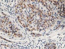 HOXC11 Antibody - IHC of paraffin-embedded Carcinoma of Human pancreas tissue using anti-HOXC11 mouse monoclonal antibody. (Heat-induced epitope retrieval by 10mM citric buffer, pH6.0, 100C for 10min).