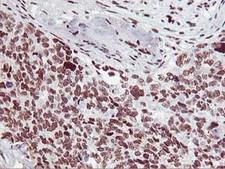 HOXC11 Antibody - IHC of paraffin-embedded Adenocarcinoma of Human breast tissue using anti-HOXC11 mouse monoclonal antibody.
