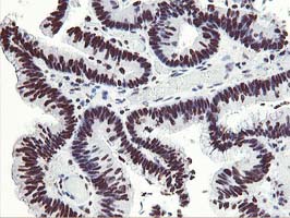 HOXC11 Antibody - IHC of paraffin-embedded Adenocarcinoma of Human colon tissue using anti-HOXC11 mouse monoclonal antibody.