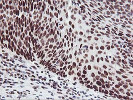 HOXC11 Antibody - IHC of paraffin-embedded Carcinoma of Human bladder tissue using anti-HOXC11 mouse monoclonal antibody.