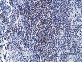 HOXC11 Antibody - IHC of paraffin-embedded Human lymphoma tissue using anti-HOXC11 mouse monoclonal antibody.