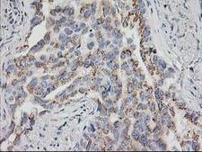 HOXC11 Antibody - IHC of paraffin-embedded Carcinoma of Human lung tissue using anti-HOXC11 mouse monoclonal antibody.