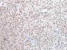 HOXC11 Antibody - Immunohistochemistry of paraffin-embedded Human ovarian cancer tissue  using HOXC11 Polyclonal Antibody at dilution of 1:25(×200)