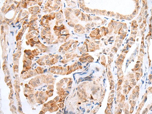 HOXC11 Antibody - Immunohistochemistry of paraffin-embedded Human thyroid cancer tissue  using HOXC11 Polyclonal Antibody at dilution of 1:25(×200)