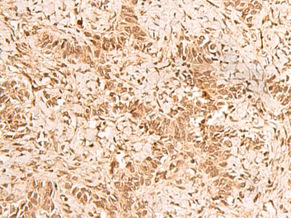 HOXC12 Antibody - Immunohistochemistry of paraffin-embedded Human ovarian cancer tissue  using HOXC12 Polyclonal Antibody at dilution of 1:50(×200)