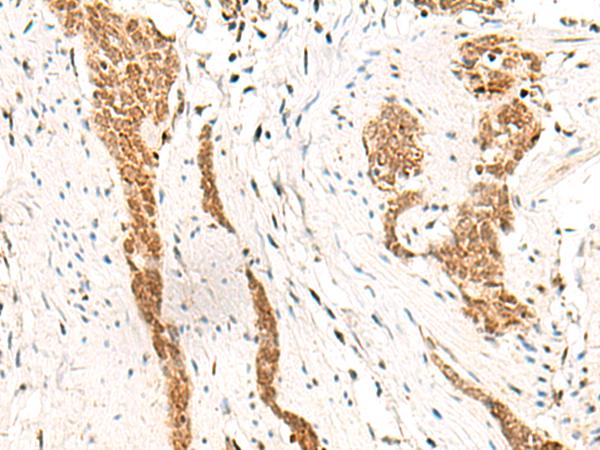 HOXC13 Antibody - Immunohistochemistry of paraffin-embedded Human esophagus cancer tissue  using HOXC13 Polyclonal Antibody at dilution of 1:60(×200)