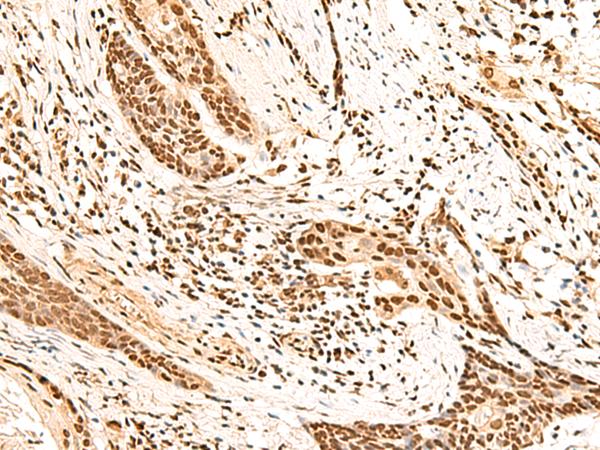 HOXC13 Antibody - Immunohistochemistry of paraffin-embedded Human esophagus cancer tissue  using HOXC13 Polyclonal Antibody at dilution of 1:60(×200)