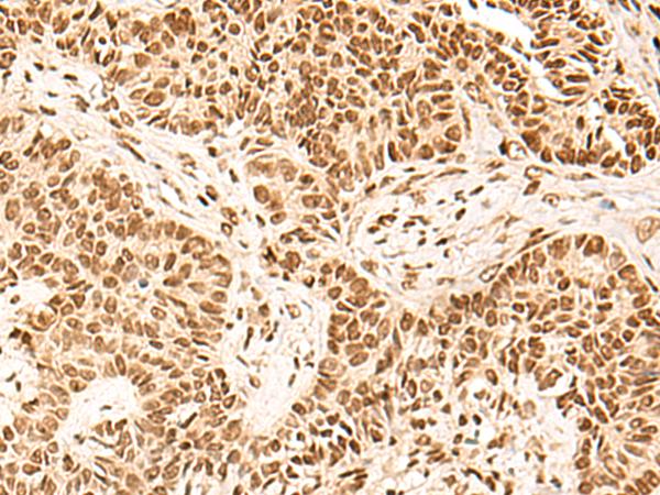 HOXC13 Antibody - Immunohistochemistry of paraffin-embedded Human ovarian cancer tissue  using HOXC13 Polyclonal Antibody at dilution of 1:60(×200)