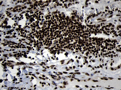 HOXC4 Antibody - Immunohistochemical staining of paraffin-embedded Carcinoma of Human lung tissue using anti-HOXC4 mouse monoclonal antibody. (Heat-induced epitope retrieval by 1mM EDTA in 10mM Tris buffer. (pH8.5) at 120°C for 3 min. (1:2000)