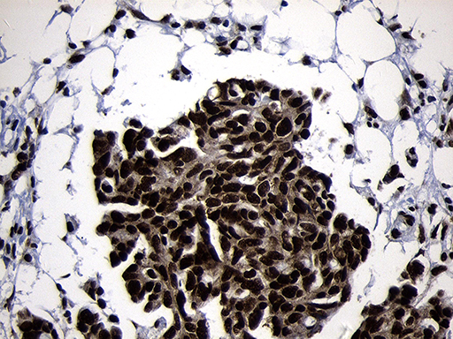 HOXC4 Antibody - Immunohistochemical staining of paraffin-embedded Adenocarcinoma of Human ovary tissue using anti-HOXC4 mouse monoclonal antibody. (Heat-induced epitope retrieval by 1mM EDTA in 10mM Tris buffer. (pH8.5) at 120°C for 3 min. (1:2000)