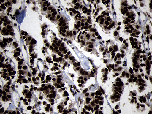HOXC4 Antibody - Immunohistochemical staining of paraffin-embedded Carcinoma of Human pancreas tissue using anti-HOXC4 mouse monoclonal antibody. (Heat-induced epitope retrieval by 1mM EDTA in 10mM Tris buffer. (pH8.5) at 120°C for 3 min. (1:2000)