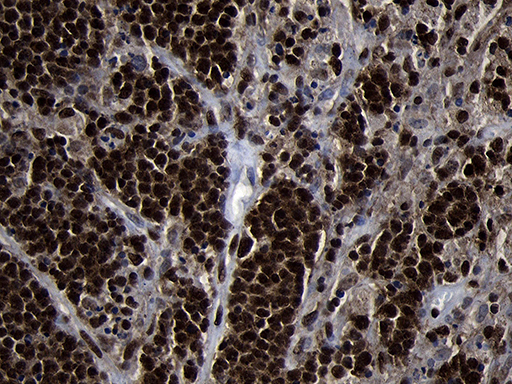 HOXC4 Antibody - Immunohistochemical staining of paraffin-embedded Human lymphoma tissue using anti-HOXC4 mouse monoclonal antibody. (Heat-induced epitope retrieval by 1mM EDTA in 10mM Tris buffer. (pH8.5) at 120°C for 3 min. (1:2000)