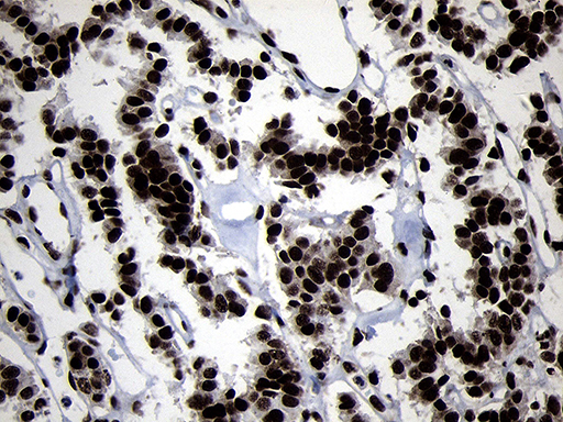 HOXC4 Antibody - Immunohistochemical staining of paraffin-embedded Carcinoma of Human pancreas tissue using anti-HOXC4 mouse monoclonal antibody. (Heat-induced epitope retrieval by 1mM EDTA in 10mM Tris buffer. (pH8.5) at 120°C for 3 min. (1:2000)