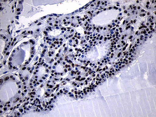 HOXC4 Antibody - Immunohistochemical staining of paraffin-embedded Carcinoma of Human thyroid tissue using anti-HOXC4 mouse monoclonal antibody. (Heat-induced epitope retrieval by 1mM EDTA in 10mM Tris buffer. (pH8.5) at 120°C for 3 min. (1:2000)