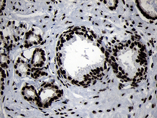 HOXC4 Antibody - Immunohistochemical staining of paraffin-embedded Carcinoma of Human prostate tissue using anti-HOXC4 mouse monoclonal antibody. (Heat-induced epitope retrieval by 1mM EDTA in 10mM Tris buffer. (pH8.5) at 120°C for 3 min. (1:2000)