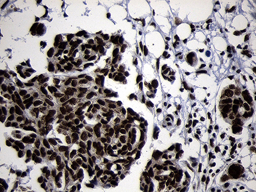 HOXC4 Antibody - Immunohistochemical staining of paraffin-embedded Adenocarcinoma of Human ovary tissue using anti-HOXC4 mouse monoclonal antibody. (Heat-induced epitope retrieval by 1mM EDTA in 10mM Tris buffer. (pH8.5) at 120°C for 3 min. (1:2000)