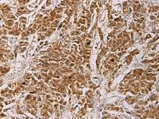 HOXC5 Antibody - Immunohistochemistry of paraffin-embedded Human colorectal cancer tissue  using HOXC5 Polyclonal Antibody at dilution of 1:55(×200)