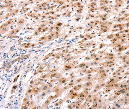 HOXC8 Antibody - Immunohistochemistry of paraffin-embedded Human liver cancer tissue.