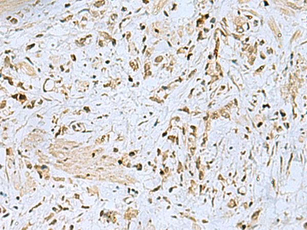 HOXC9 Antibody - Immunohistochemistry of paraffin-embedded Human gastric cancer tissue  using HOXC9 Polyclonal Antibody at dilution of 1:40(×200)