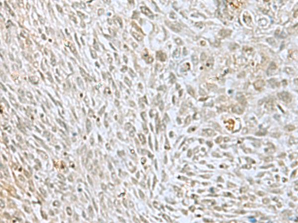 HOXC9 Antibody - Immunohistochemistry of paraffin-embedded Human lung cancer tissue  using HOXC9 Polyclonal Antibody at dilution of 1:40(×200)