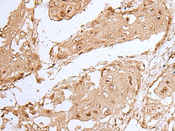 HOXC9 Antibody - Immunohistochemistry of paraffin-embedded Human esophagus cancer tissue  using HOXC9 Polyclonal Antibody at dilution of 1:35(×200)