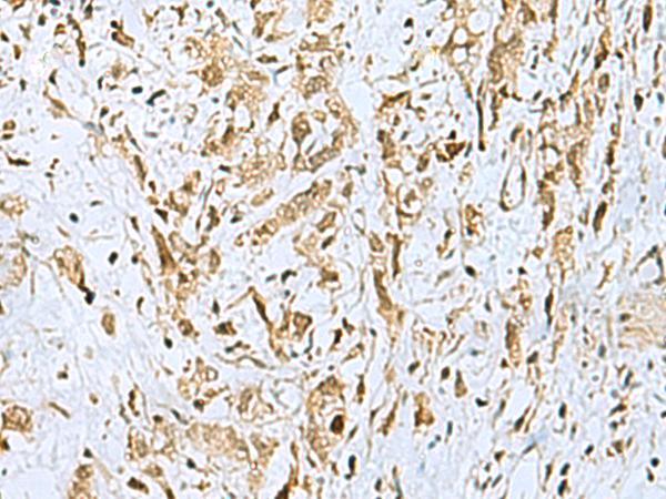 HOXC9 Antibody - Immunohistochemistry of paraffin-embedded Human gastric cancer tissue  using HOXC9 Polyclonal Antibody at dilution of 1:110(×200)