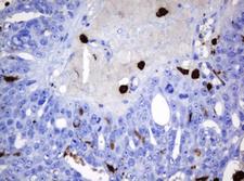 HOXD10 Antibody - IHC of paraffin-embedded Adenocarcinoma of Human ovary tissue using anti-HOXD10 mouse monoclonal antibody. (Heat-induced epitope retrieval by 10mM citric buffer, pH6.0, 120°C for 3min).